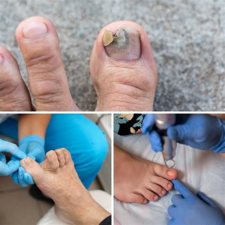 Toenail Fungus - Onychomycosis or tinea unguium - OC Foot and Ankle Clinic