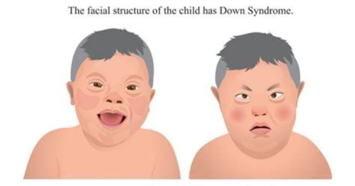 Understanding The Journey: Hugh Grant's Daughter With Down Syndrome