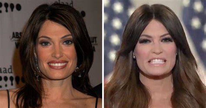 Unveiling The Truth Behind Kimberly Guilfoyle's Face Lift