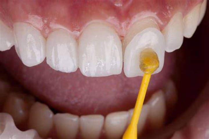 Veneers Are Not A Permanent Solution, And They May Need To Be Replaced Every 10-15 Years., Gscseven