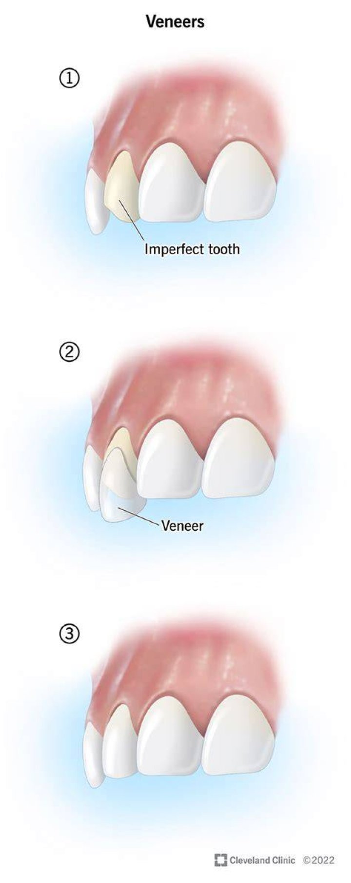 Veneers Can Be Used To Correct A Variety Of Dental Issues, Including Gaps, Chips, And Discoloration., Gscseven
