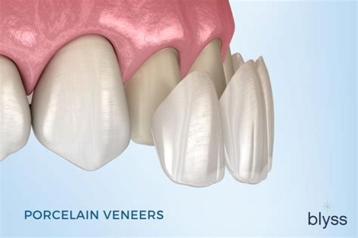 Veneers, Gscseven