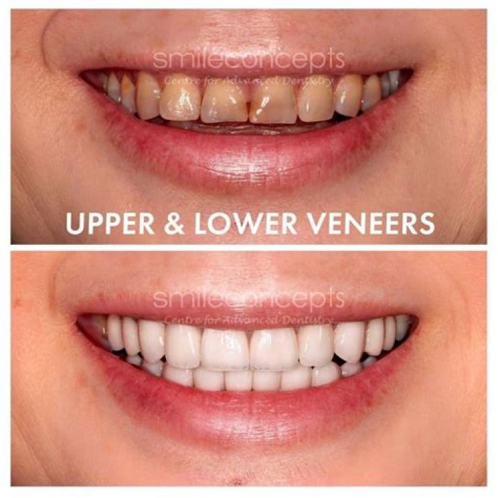 Veneers Have Helped To Correct This Issue And Give Cardi B A More Polished And Symmetrical Smile., Gscseven