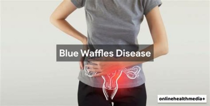 What Is Blue Waffle Disease? Everything You Need to Know