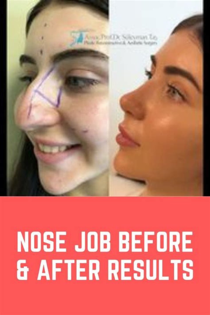 Whitney Port Nose Job: The Ultimate Guide