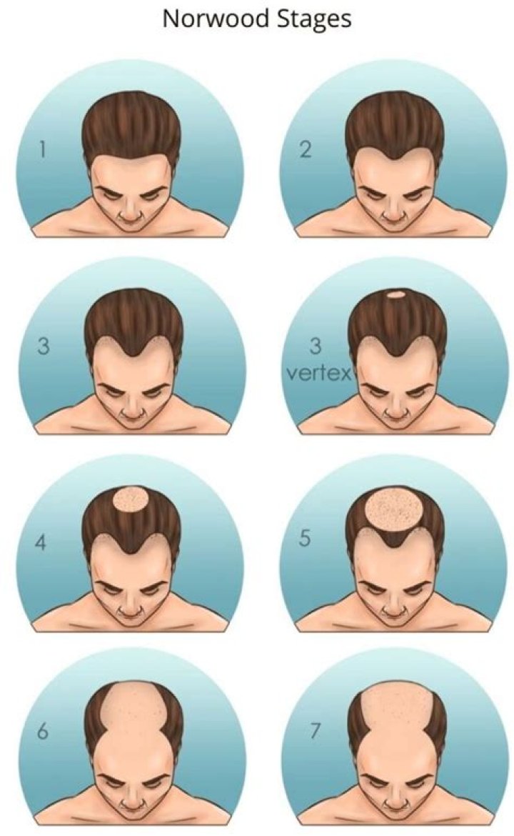 Why Do Most Guys Have Red In Their Beards? Ginger Hair Transformation